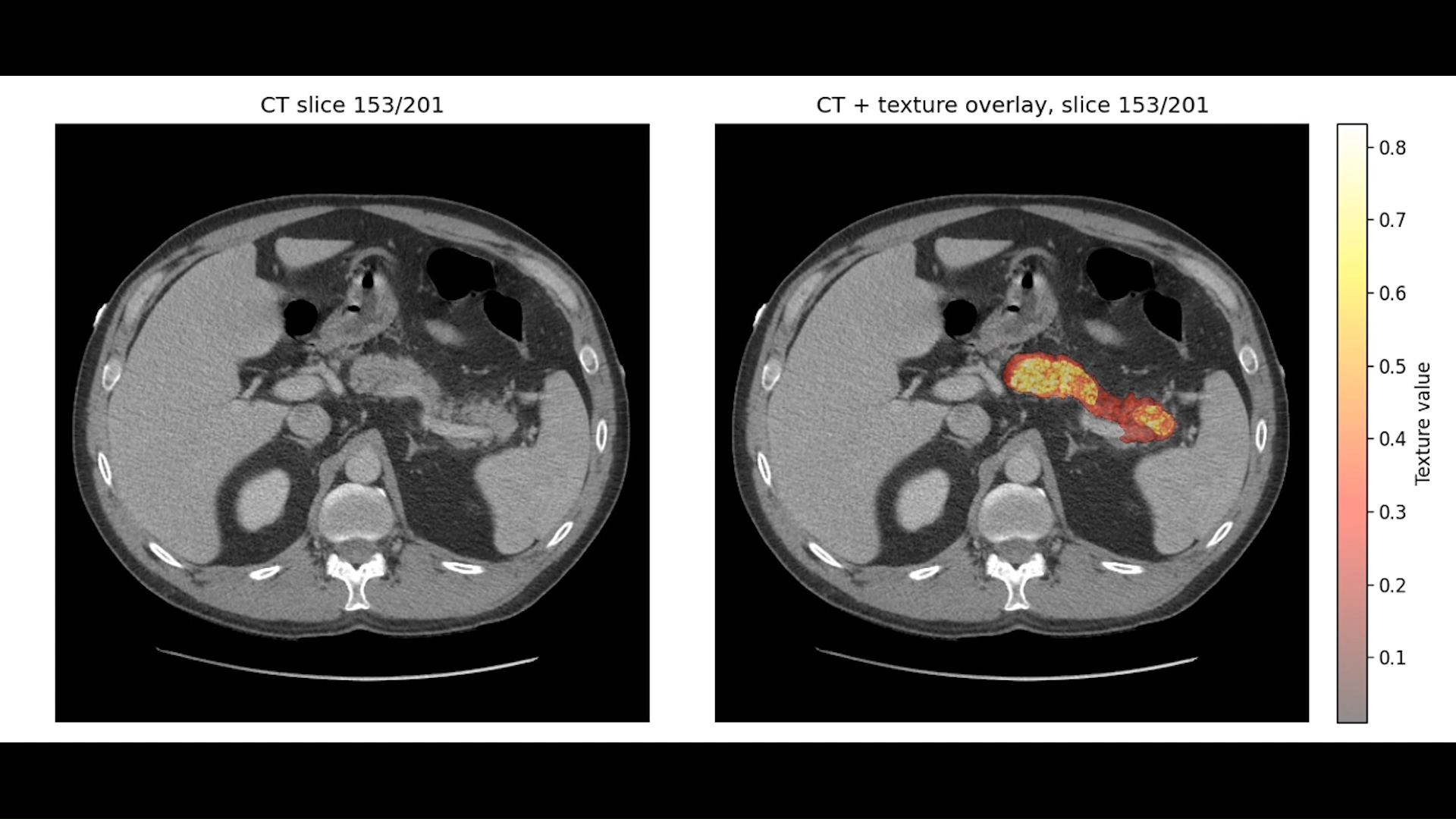 Ilmuwan Kembangkan AI yang Bisa Mendeteksi Kanker Pankreas Sebelum Tumor Terlihat